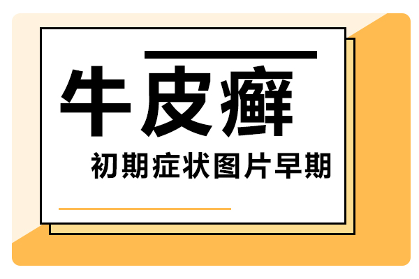 [阅读越健康]得了牛皮癣,科学饮食要注意.“吃”掉牛皮癣.